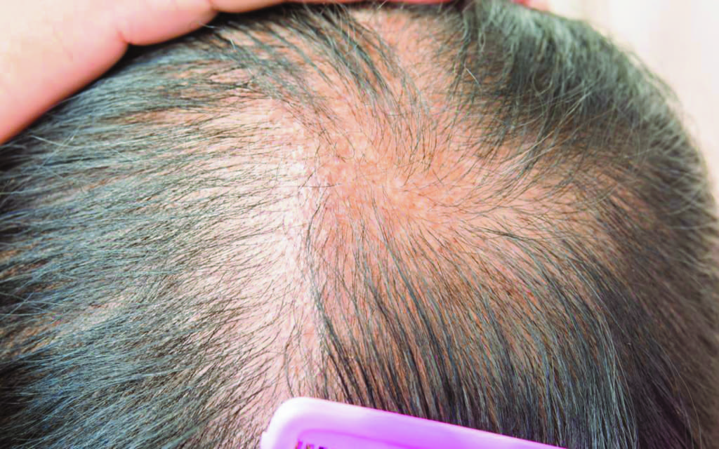 Hair loss: Common causes and prevention...